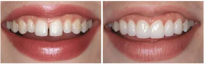 Картинка зубов после снятия виниров
