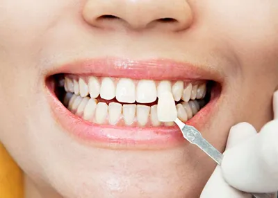 Откровенные фото: зубы после снятия виниров
