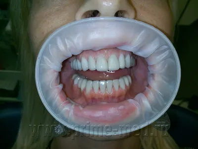 Честное фото: зубы после снятия виниров