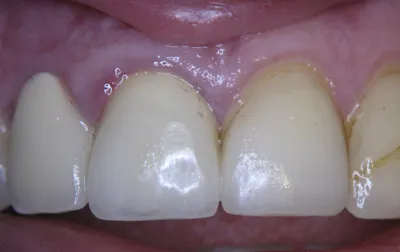 Реальные фото: зубы после снятия виниров
