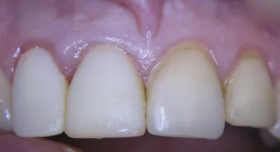 Честный фотоотчет: зубы после снятия виниров