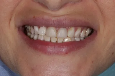 Фото до и после: изменения на зубах после снятия виниров