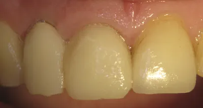 Неожиданный эффект: как выглядят зубы после снятия виниров на фото