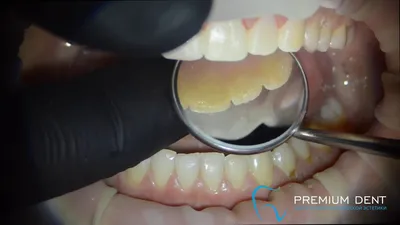 Фотоотчет: зубы после снятия виниров