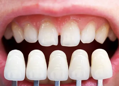 Изображение зубов после процедуры снятия виниров