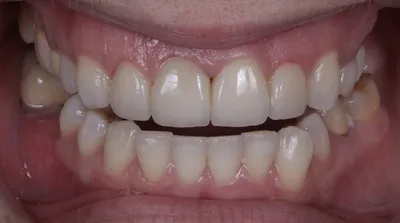 Без виниров: настоящее фото ваших зубов