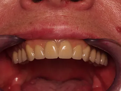 Без виниров: фото зубов до и после