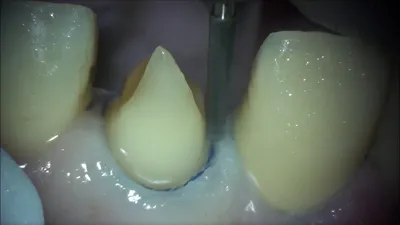 Изображение: изменения зубов после снятия виниров