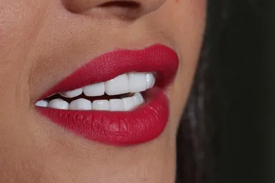Зубы после снятия виниров: как они выглядят? Фото