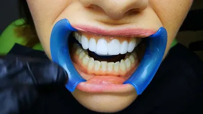 Как выглядят зубы без виниров: фото